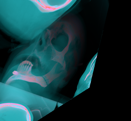 Teaser