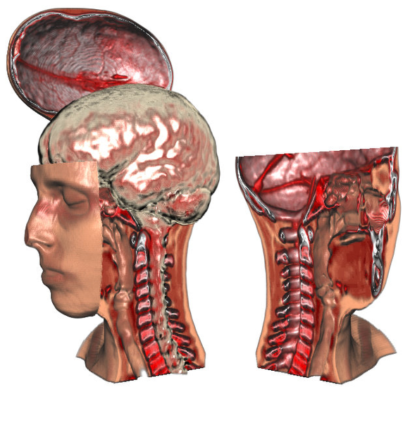 Image: Exploded volume data view using part constraints