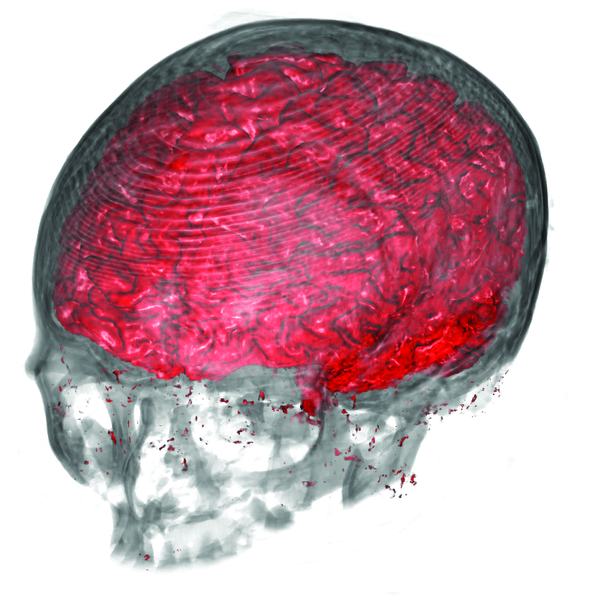 CT-MRI: Multimodal Visualization of CT and MRI