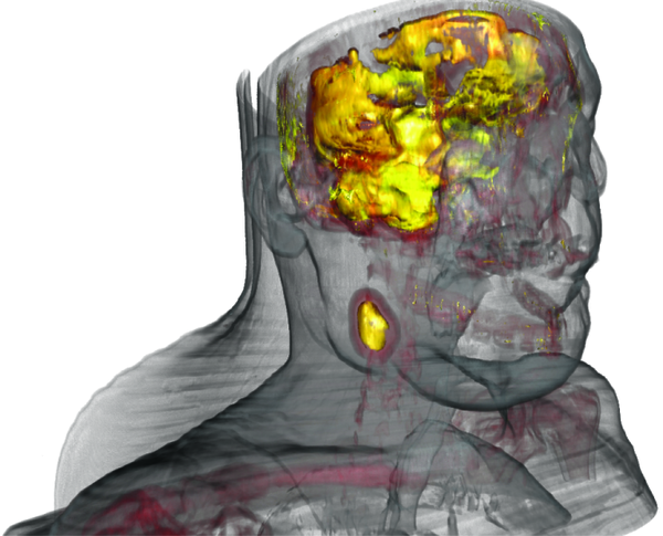 CT-PET: Multimodal Visualization of Neck Tumor
