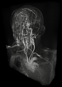 Teaser: Maximum Intensity Difference Accumulation (MIDA) of an MRI angiography data set