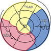 patient-specific bulls eye plot