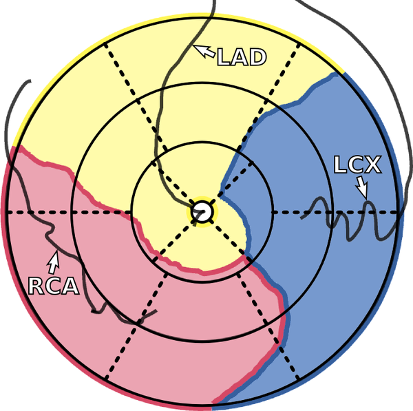 image: patient-specific bulls eye plot